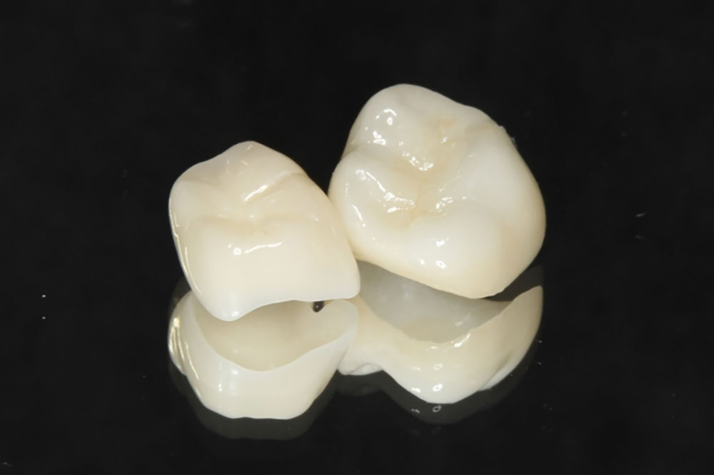 オールセラミッククラウン