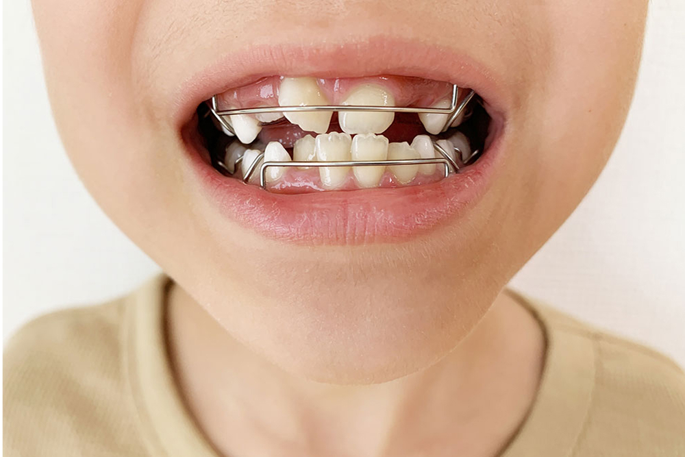 抜歯のリスクが少ない！