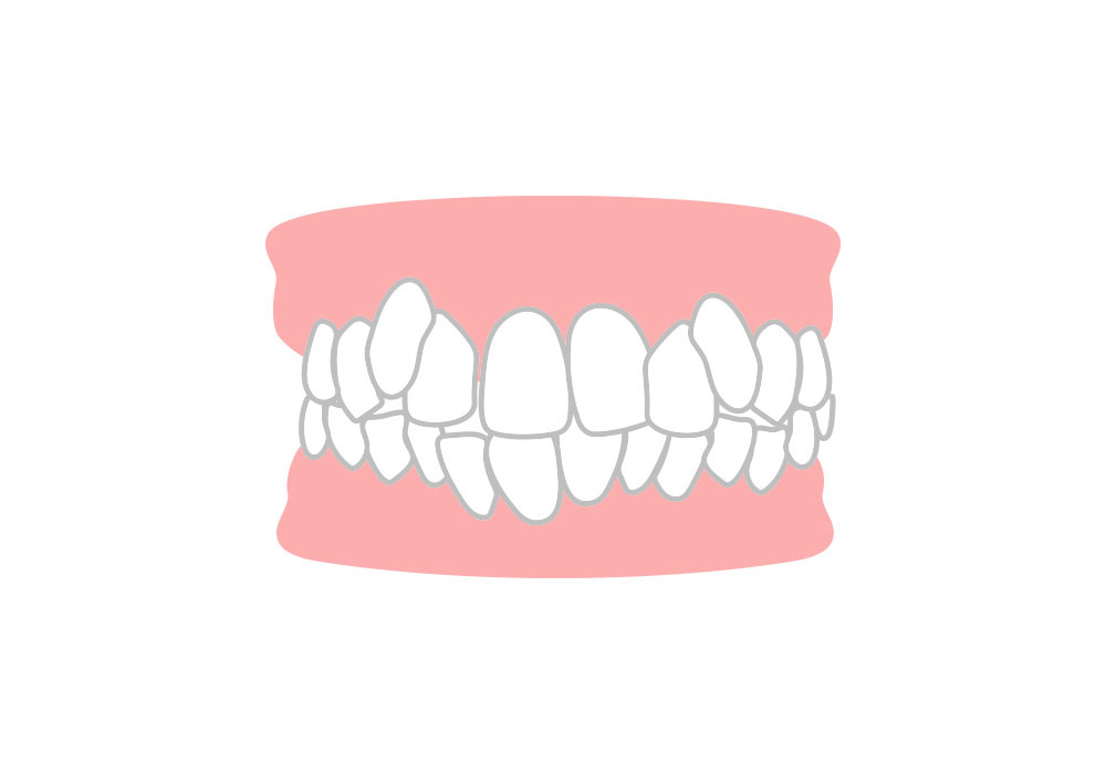 重度の叢生（そうせい）