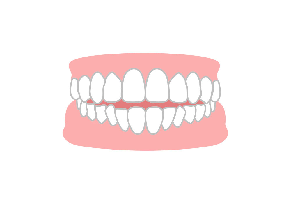 上下の歯の開口