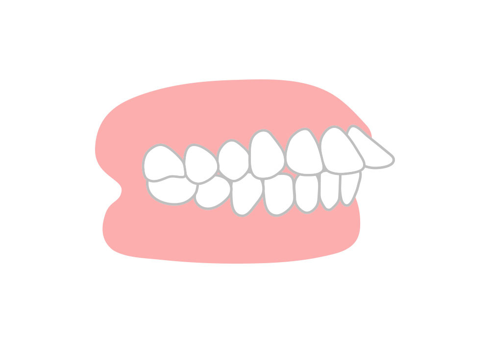 大きく前へ出ている出っ歯