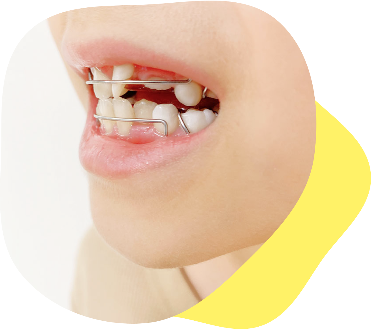 抜歯のリスクが少ない！