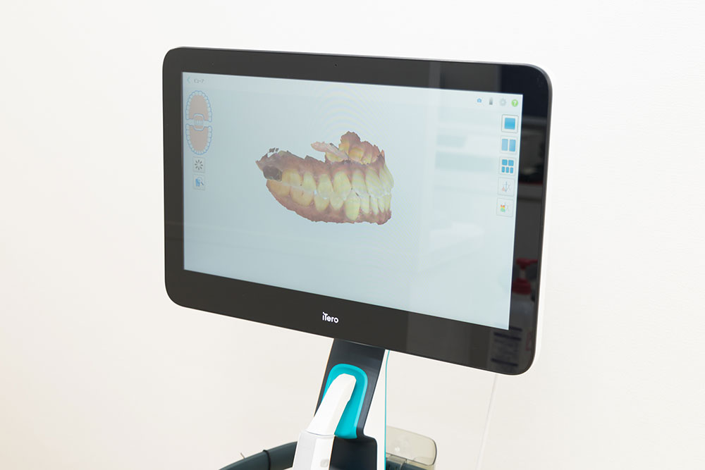 ドナー歯の選定